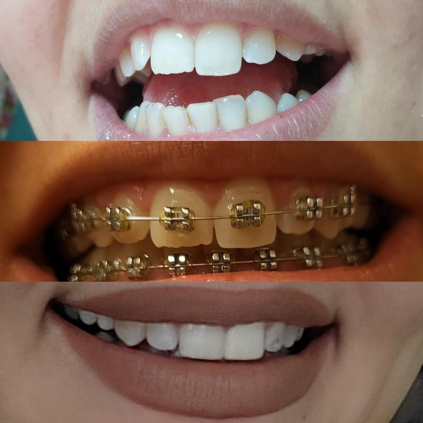 Fixed orthodontics — full alignment
