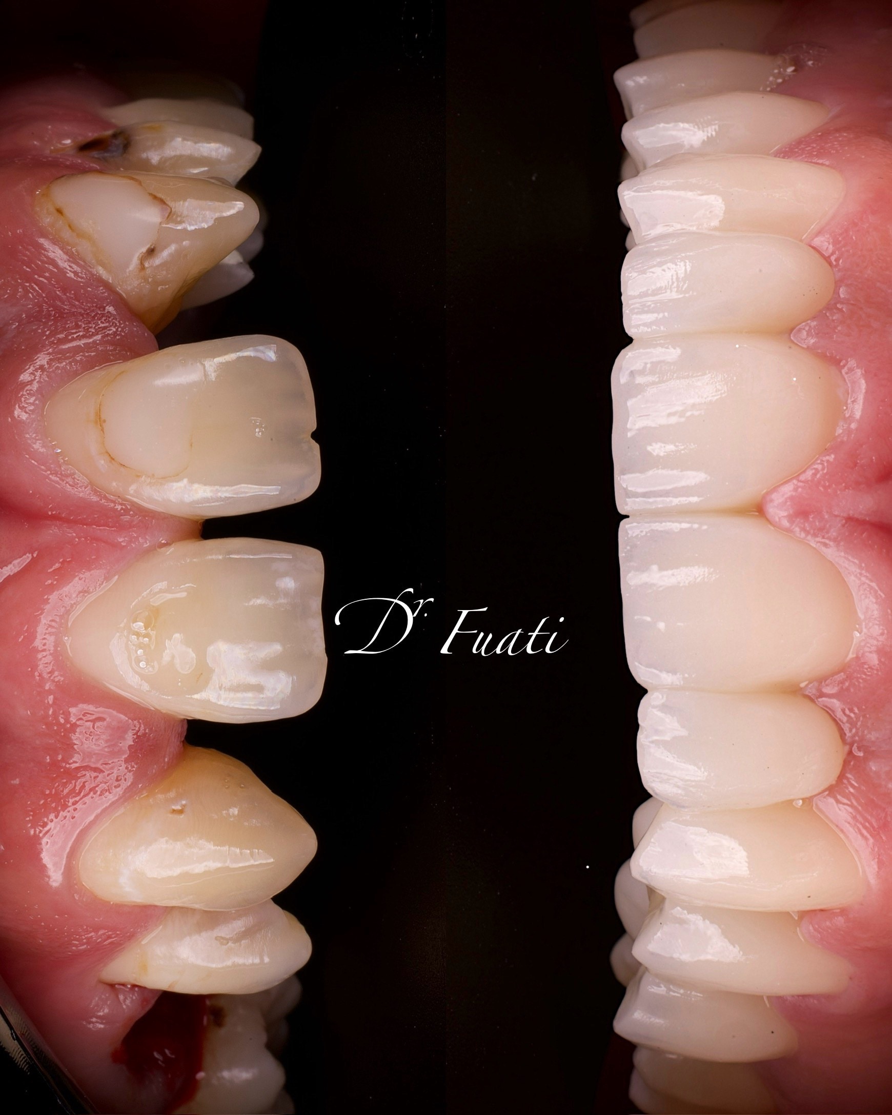 Zirconia restoration — anterior segment
