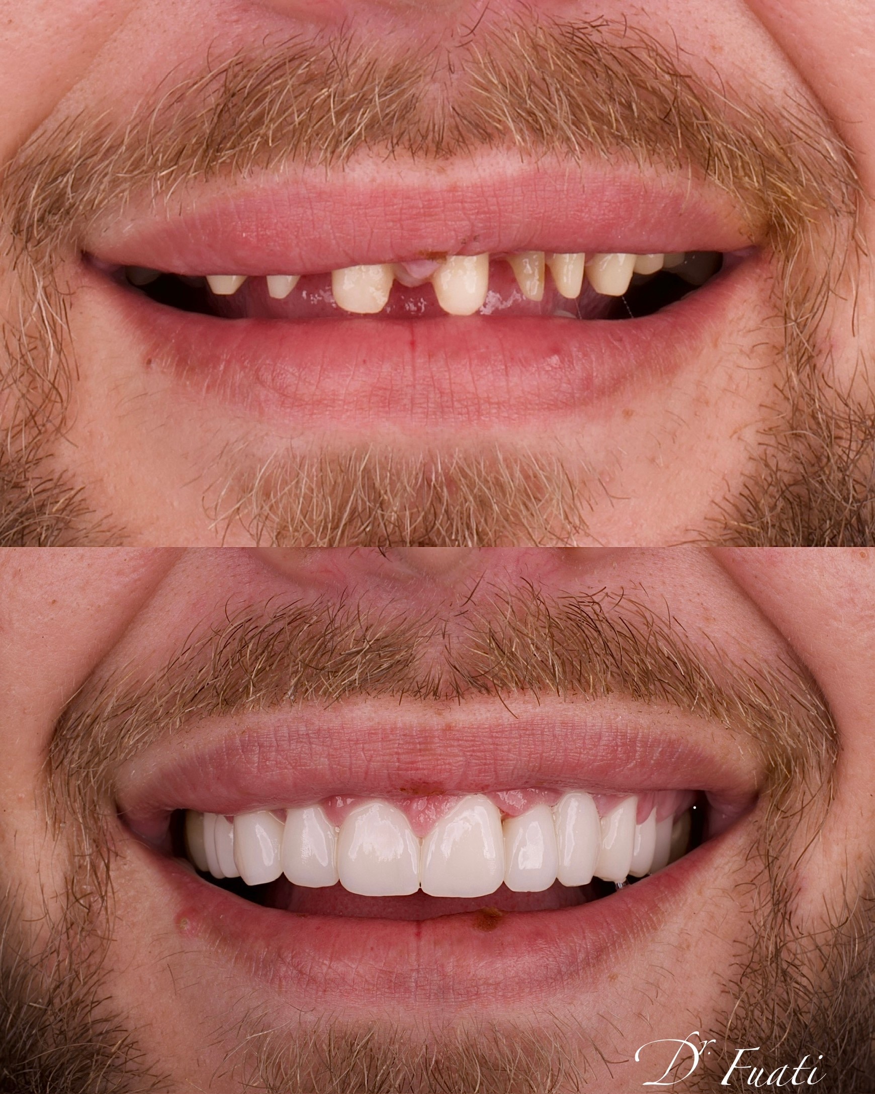 Full-smile reconstruction