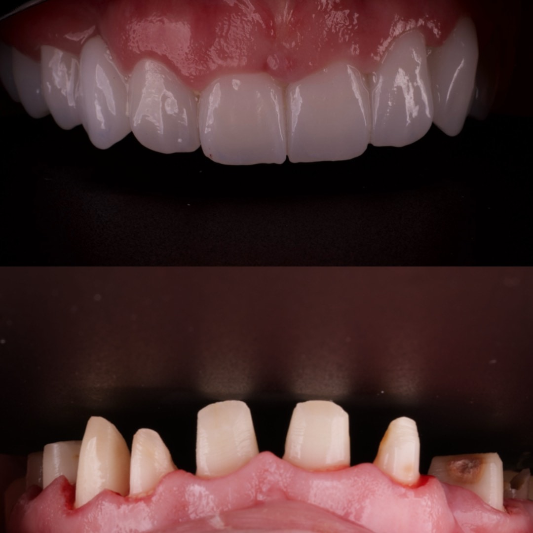 Ceramic restoration — worn dentition
